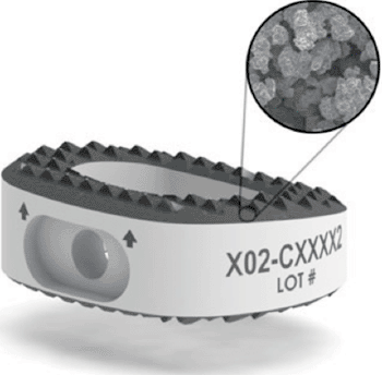 Image: The TyPEEK transforaminal lumbar interbody fusion (TLIF) device (Photo courtesy of Tyber Medical). Image: The TyPEEK transforaminal lumbar interbody fusion (TLIF) device (Photo courtesy of Tyber Medical).